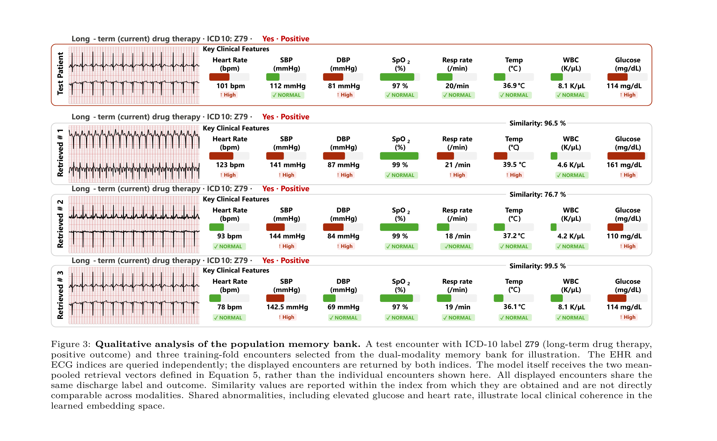 Qualitative analysis of the population memory bank. A test encounter with ICD-10 label Z79 (long-term drug therapy, positive outcome) and three training-fold encounters retrieved from the dual-modality memory bank, each showing an ECG strip and key clinical features with abnormality flags.